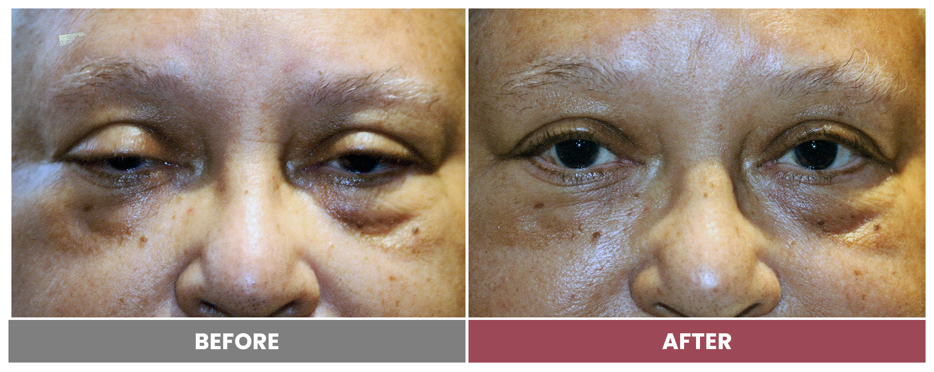 PTOSIS REPAIR - Case 63